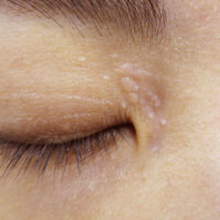 目の周りのいぼかんかん腫（汗管腫）のレーザー治療