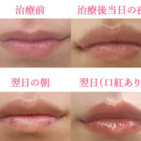 唇ヒアルロン酸の変化