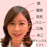 私のボトックス部位