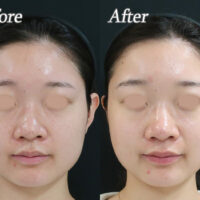 えらボトックス症例